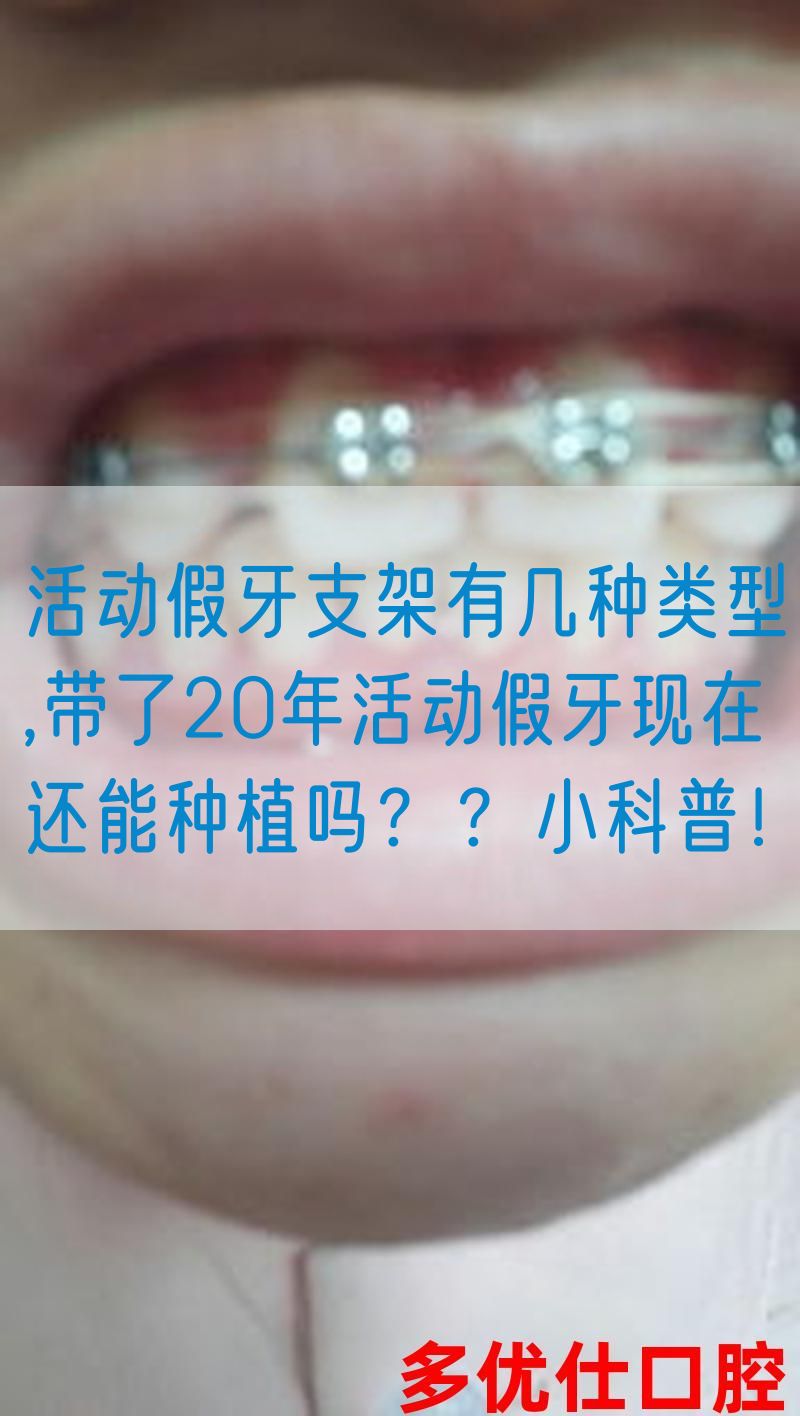 活动假牙支架有几种类型,带了20年活动假牙现在还能种植吗？？小科普！(图1)