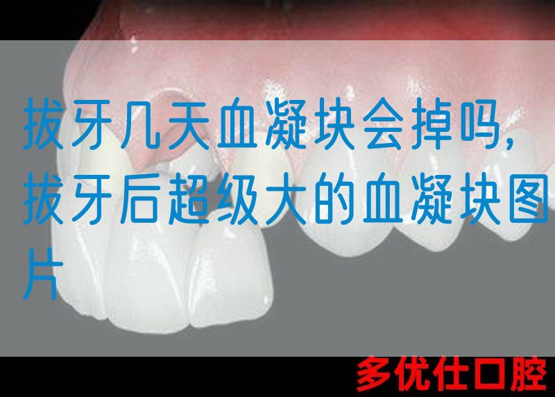 拔牙几天血凝块会掉吗,拔牙后超级大的血凝块图片(图1)