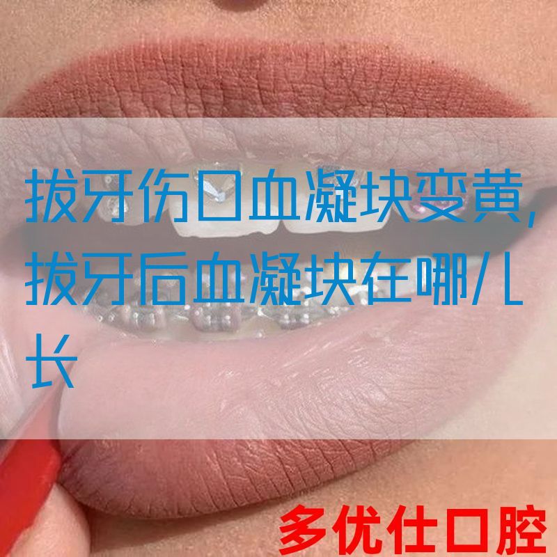 拔牙伤口血凝块变黄,拔牙后血凝块在哪儿长(图1)