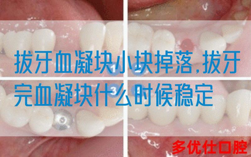 拔牙血凝块小块掉落,拔牙完血凝块什么时候稳定(图1)