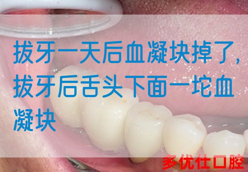 拔牙一天后血凝块掉了,拔牙后舌*下面一坨血凝块(图1)