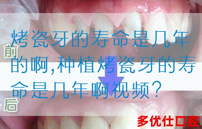 烤瓷牙的寿命是几年的啊,种植烤瓷牙的寿命是几年啊视频？(图1)