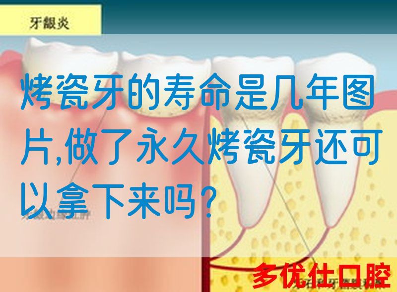 烤瓷牙的寿命是几年图片,做了*烤瓷牙还可以拿下来吗？(图1)
