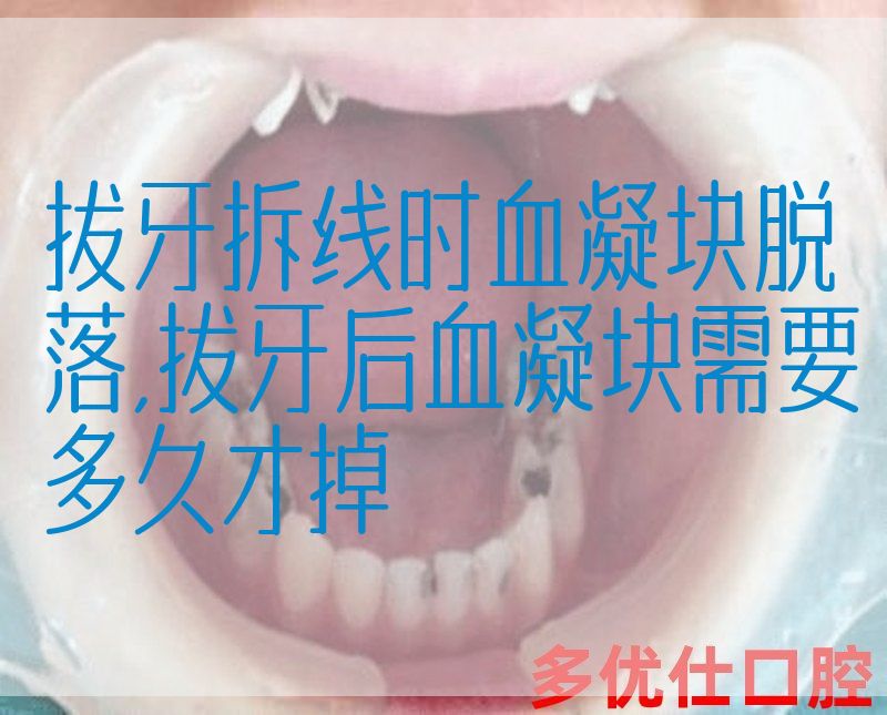 拔牙拆线时血凝块脱落,拔牙后血凝块需要多久才掉(图1)