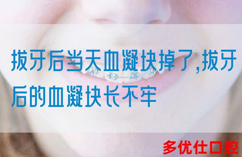 拔牙后当天血凝块掉了,拔牙后的血凝块长不牢(图1)