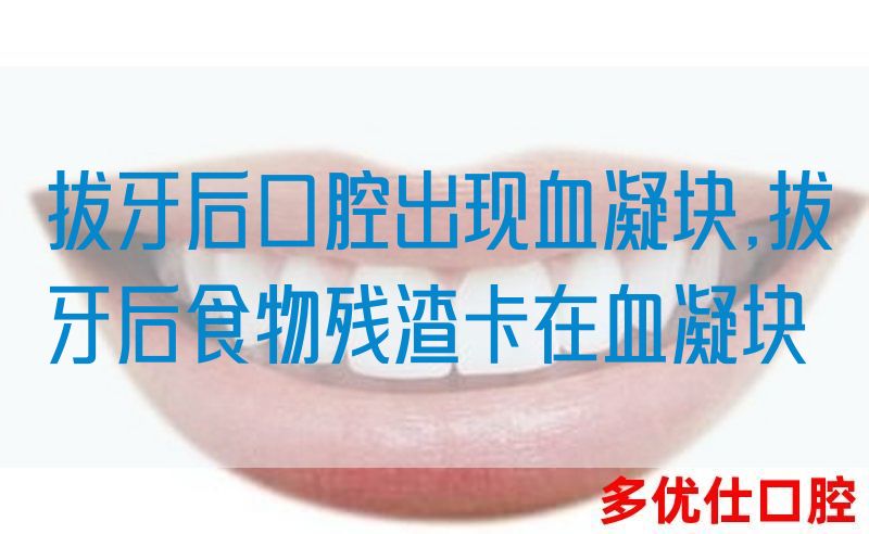 拔牙后口腔出现血凝块,拔牙后食物残渣卡在血凝块(图1)