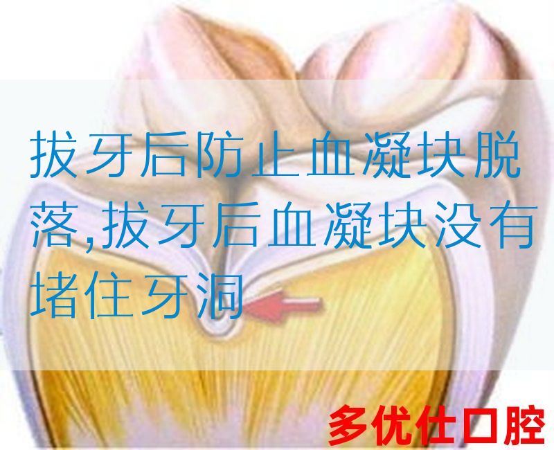 拔牙后防止血凝块脱落,拔牙后血凝块没有堵住牙洞(图1)