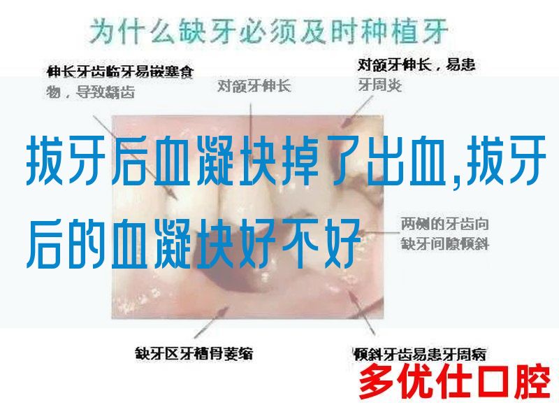 拔牙后血凝块掉了出血,拔牙后的血凝块好不好(图1)