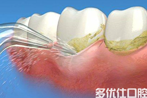 牙齿为什么会从根部腐蚀