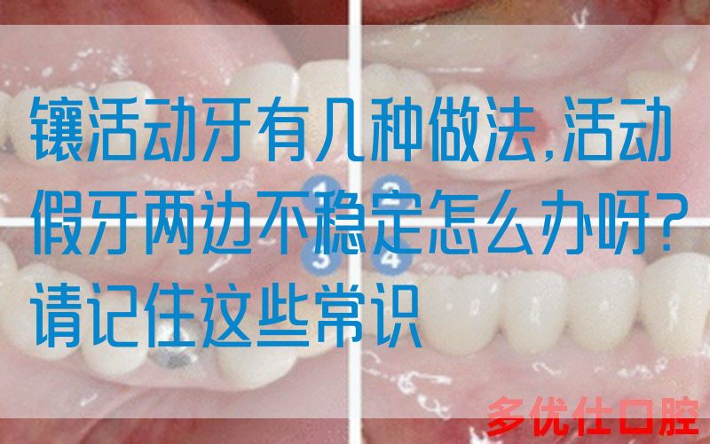 镶活动牙有几种做法,活动假牙两边不稳定怎么办呀？请记住这些常识