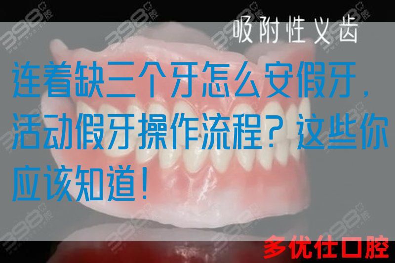 连着缺三个牙怎么安假牙，活动假牙操作流程？这些你应该知道！(图1)