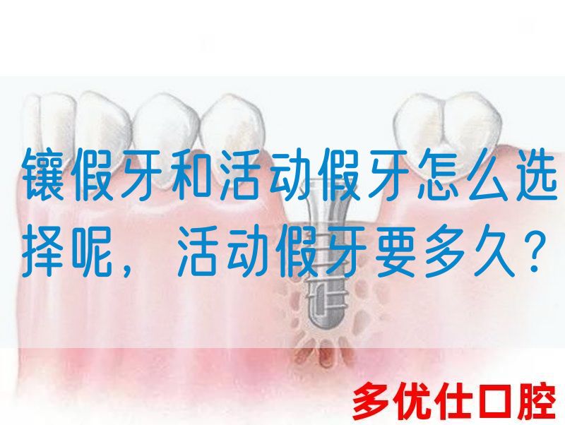 镶假牙和活动假牙怎么选择呢，活动假牙要多久？