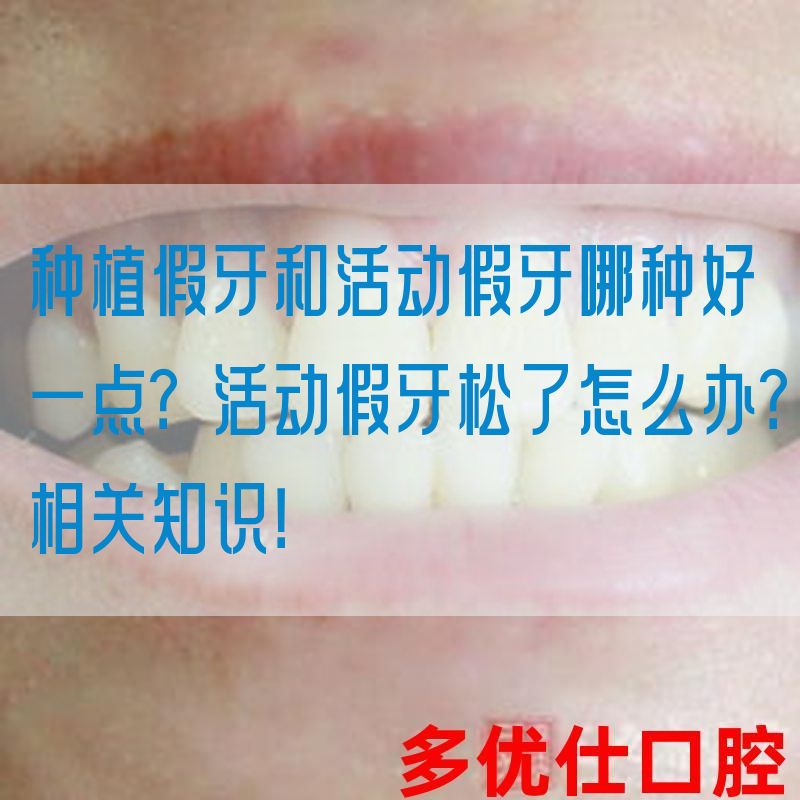 种植假牙和活动假牙哪种好一点？活动假牙松了怎么办？相关知识！(图1)