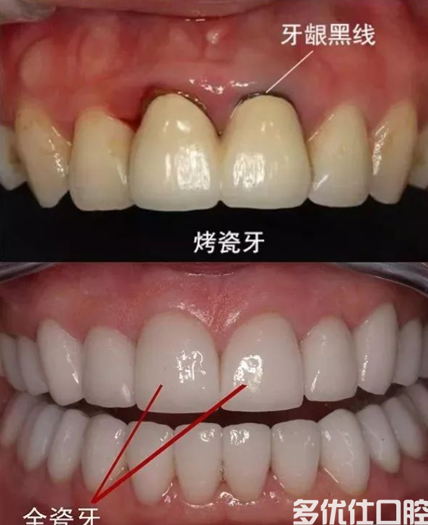 1000元的全瓷牙和1500的有什么区别大吗?