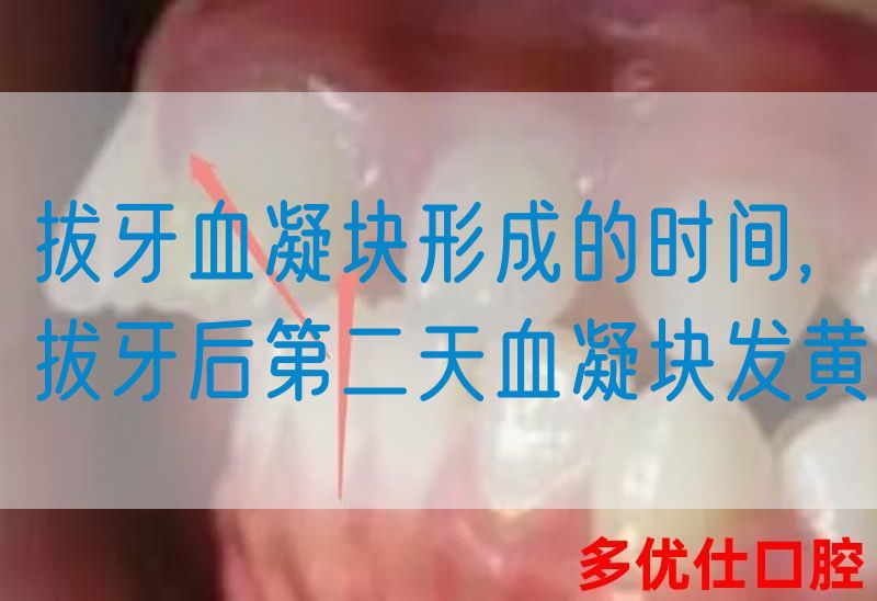 拔牙血凝块形成的时间,拔牙后第二天血凝块发黄(图1)