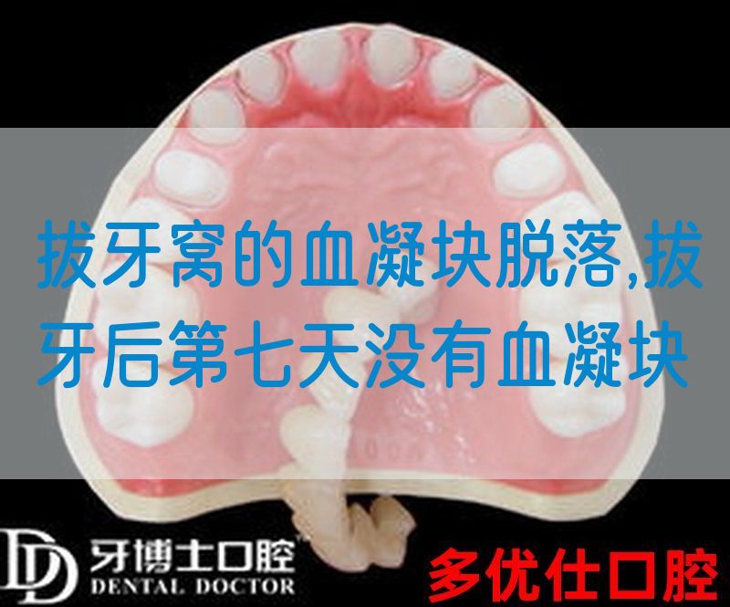 拔牙窝的血凝块脱落,拔牙后第七天没有血凝块(图1)