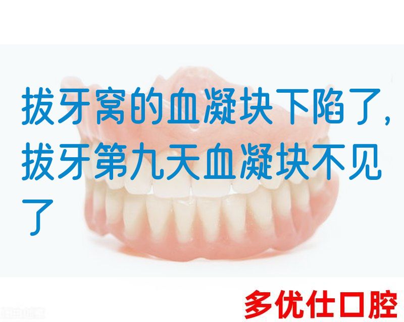 拔牙窝的血凝块下陷了,拔牙第九天血凝块不见了(图1)