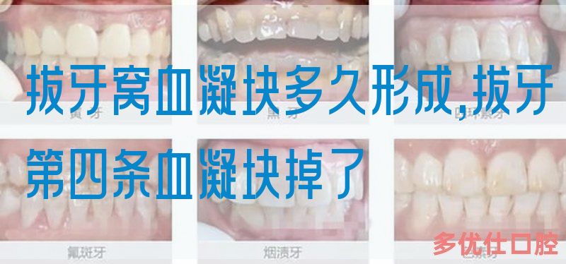 拔牙窝血凝块多久形成,拔牙第四条血凝块掉了(图1)