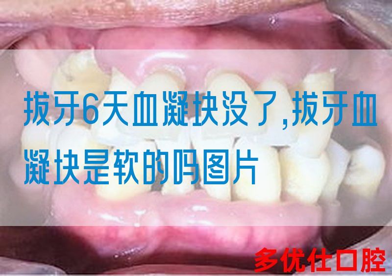 拔牙6天血凝块没了,拔牙血凝块是软的吗图片(图1)