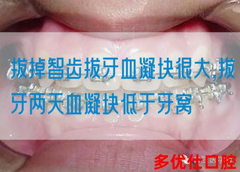 拔掉智齿拔牙血凝块很大,拔牙两天血凝块低于牙窝(图1)