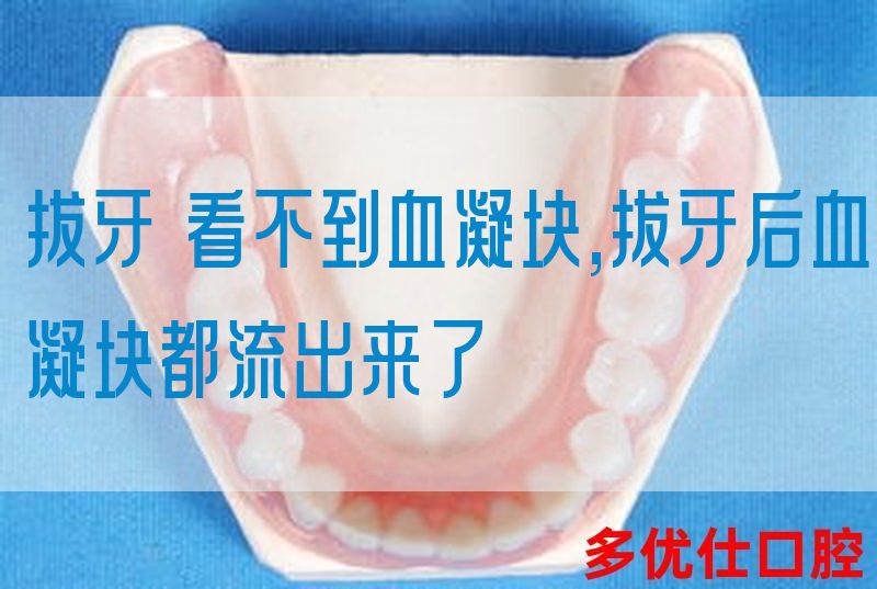 拔牙 看不到血凝块,拔牙后血凝块都流出来了(图1)