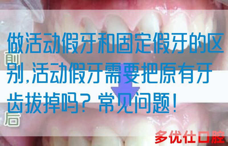 做活动假牙和固定假牙的区别,活动假牙需要把原有牙齿拔掉吗？常见问题！