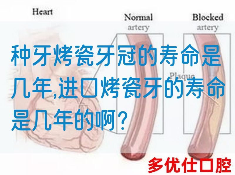 种牙烤瓷牙冠的寿命是几年,进口烤瓷牙的寿命是几年的啊？