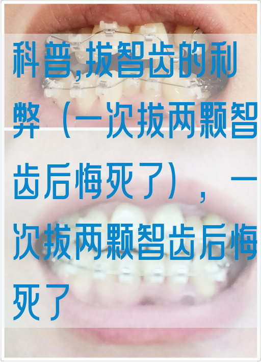 科普,拔智齿的利弊（一次拔两颗智齿后悔*了），一次拔两颗智齿后悔*了(图1)