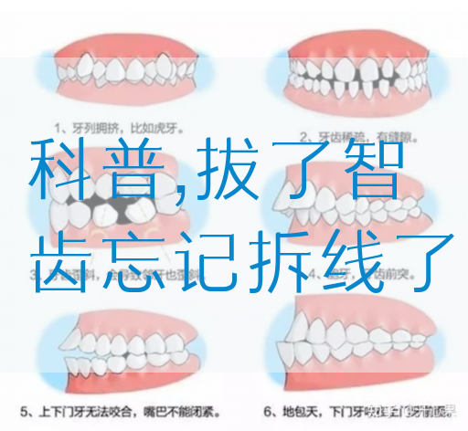 科普,拔了智齿忘记拆线了(图1)
