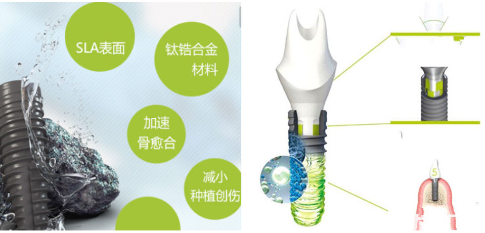 iti种植体三种型号的区别及优缺点对比