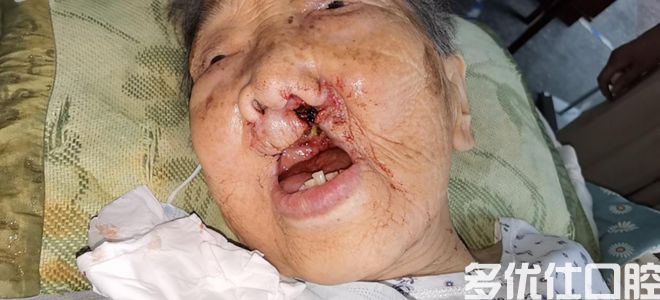固始县人民医院口腔科成功开展口腔颌面外科手术(图15)