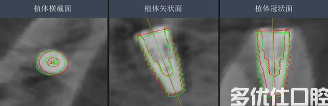 哈医大四院口腔科成功开展首例种植机器人手术(图2)