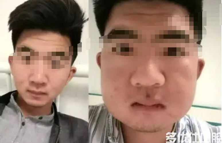 分享我很后悔拔了4颗智齿这件事