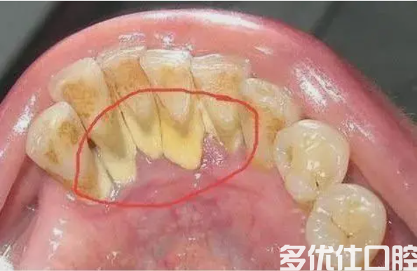 牙结石不去除会越来越严重