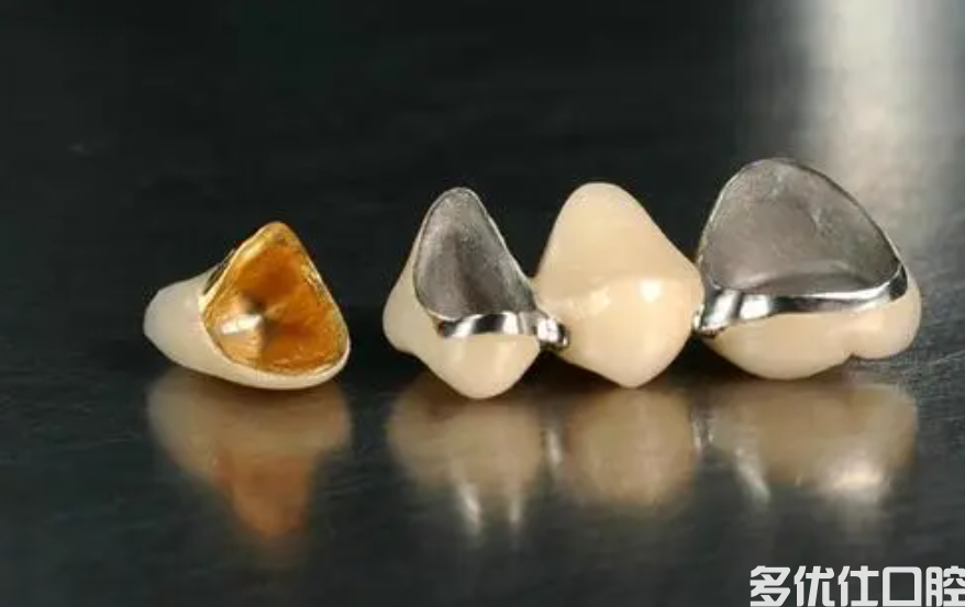 烤瓷牙多少钱一颗？