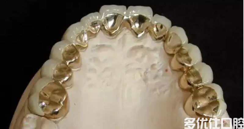 烤瓷牙多少钱一颗？