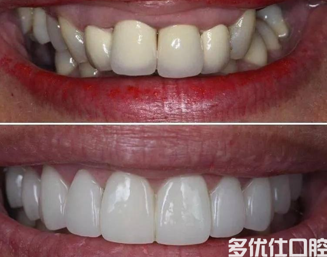 烤瓷牙多少钱一颗？