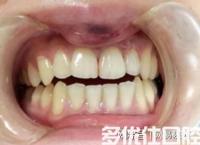 西安市红会医院口腔科完成自体牙再植入术(图2)