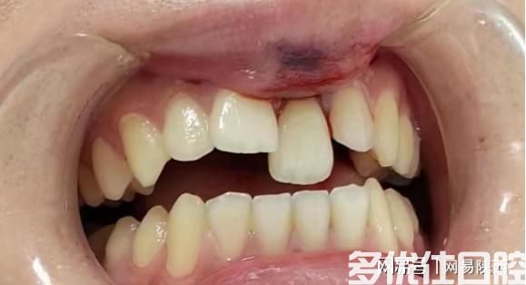 西安市红会医院口腔科完成自体牙再植入术(图1)