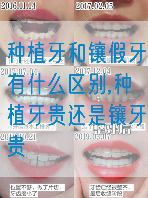 种植牙和镶假牙有什么区别,种植牙贵还是镶牙贵(图1)