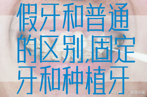 一次性全口假牙和普通的区别,固定牙和种植牙有什么区别(图1)