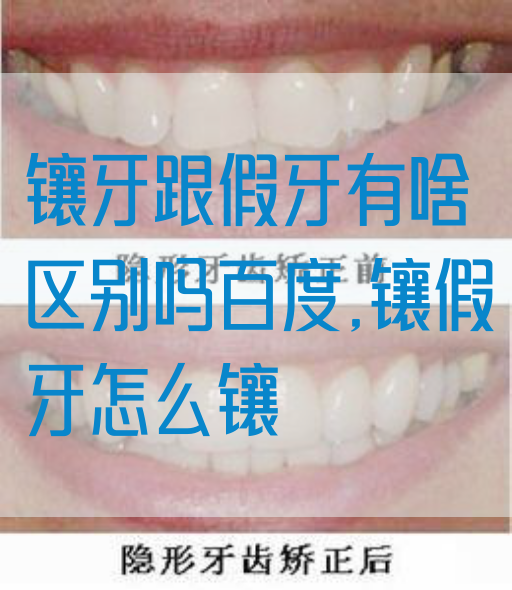 镶牙跟假牙有啥区别吗百度,镶假牙怎么镶(图1)