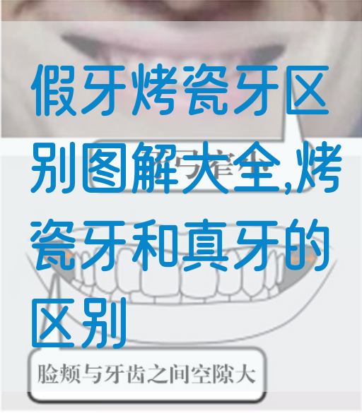 假牙烤瓷牙区别图解大全,烤瓷牙和真牙的区别(图1)