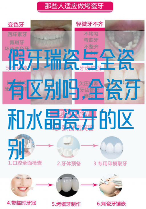 假牙瑞瓷与全瓷有区别吗,全瓷牙和水晶瓷牙的区别(图1)