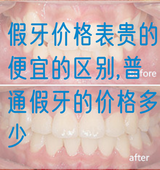 假牙价格表贵的便宜的区别,普通假牙的价格多少(图1)