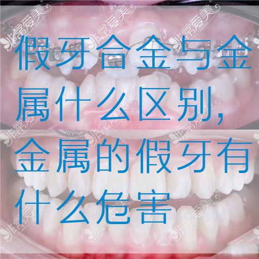 假牙合金与金属什么区别,金属的假牙有什么危害(图1)
