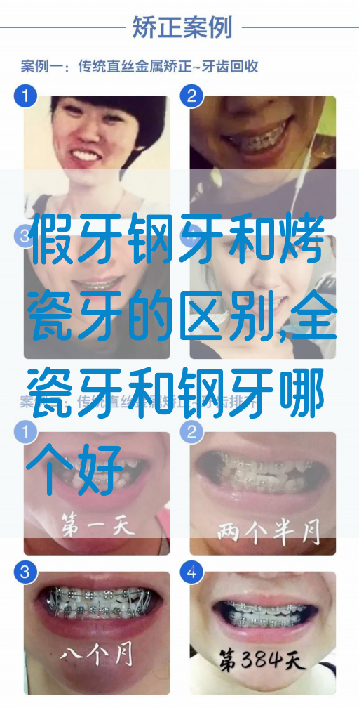 假牙钢牙和烤瓷牙的区别,全瓷牙和钢牙哪个好(图1)