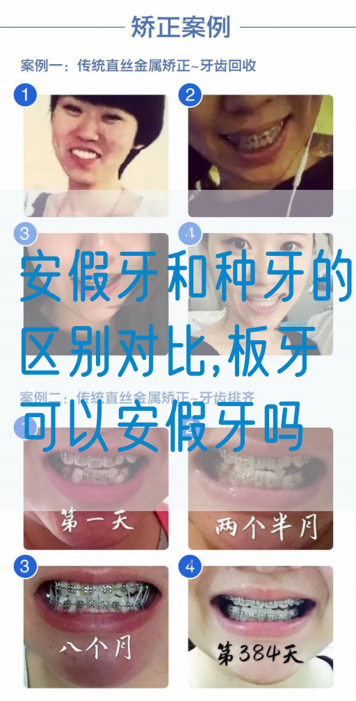 安假牙和种牙的区别对比,板牙可以安假牙吗(图1)
