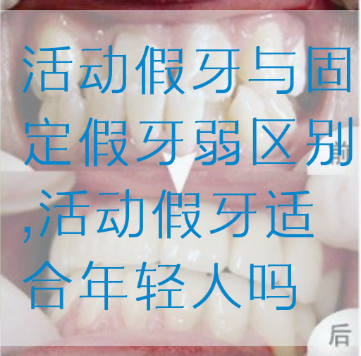 活动假牙与固定假牙弱区别,活动假牙适合年轻人吗(图1)