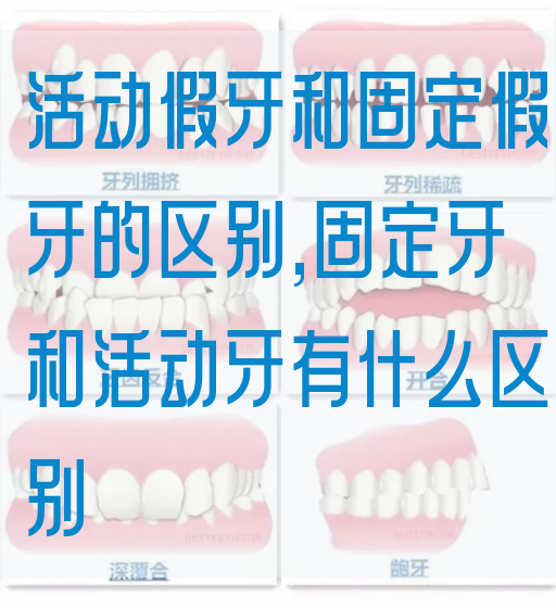 活动假牙和固定假牙的区别,固定牙和活动牙有什么区别(图1)